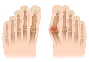 haluks valgus - čukalj na stopalu