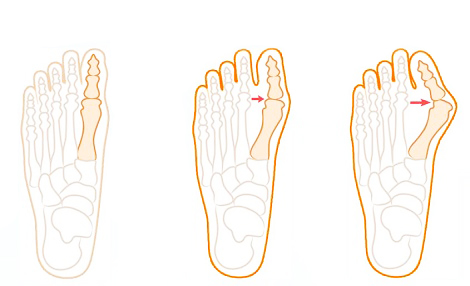 Haluks valgus deformacija (čukalj)