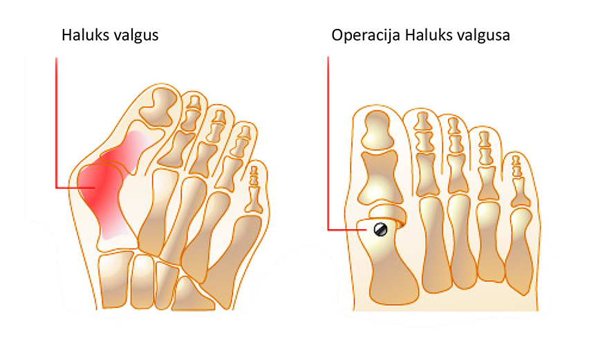 operacija haluks valgusa