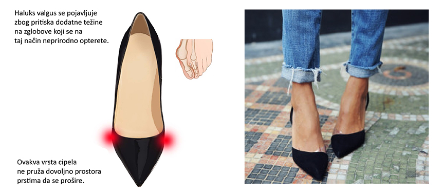 Deformirani palac (čukalj) se znatno češće javlja kod žena nego muškaraca