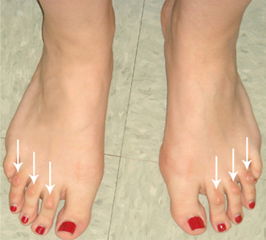 tilomi ili bolni natisci se javljaju uglavnom kod osoba sa statički deformiranim stopalima